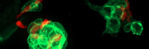 Microscopy image of tumorigenic kertinocytes and neutrophils