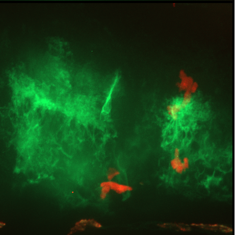 Microscopy of tumorigenic glioblastoma cells and neutrophils in zebrafish